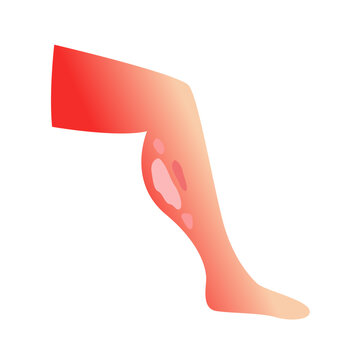 Burned skin. vector illustration design