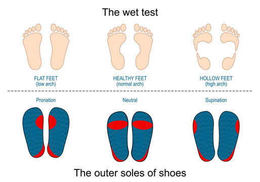 Wet test and outer soles of shoes. Normal, Supination, Pronation