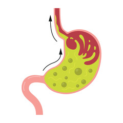 An illustration of a human stomach with gastritis or heartburn, showing food mixing with acid, reflecting digestive problems, as well as characteristic symptoms