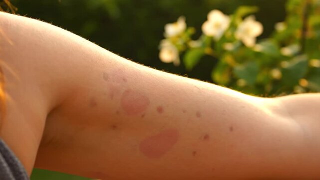 Skin Allergic Reaction on Caucasian Woman's Arm Featuring Red Wheals and Inflammation against a Green Natural