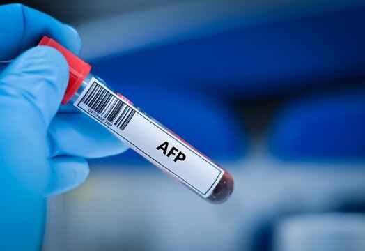 Blood sample tube for alpha fetoprotein test analysis.