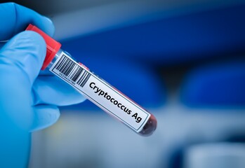Fototapeta premium Blood sample tube for cryptococcus Ag test analysis.