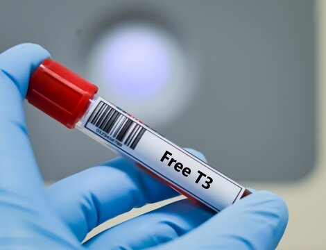 Blood sample tube for Free T3 test analysis.