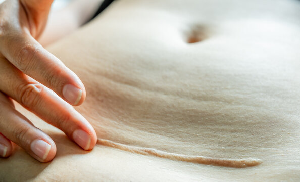 Close-up of a healed C-section scar on a woman's belly with a hand gently touching the skin. Concept of postpartum body reality, maternal healthcare, and the strength of motherhood
