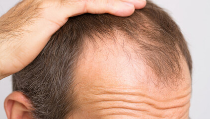 Fototapeta premium Young man observing his thinning hair and balding scalp, searching for solutions for hair loss and alopecia