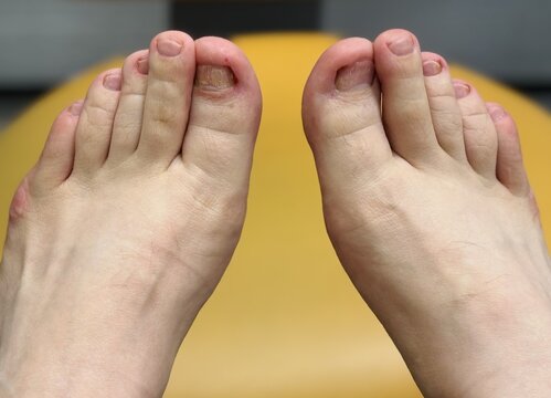 Onychomycosis. A dangerous fungal infection of the toenails of a person sitting in a doctor's examination chair. Disease and detachment of the nail plate. Close-up.