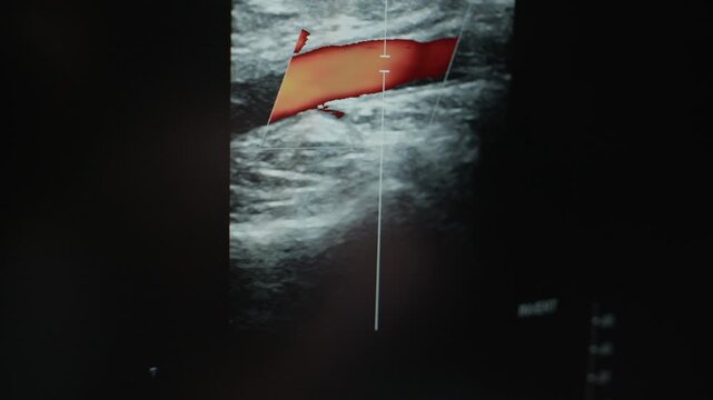 Close up no people shot of ultrasound machine displaying triplex ultrasound scan with color flow imaging, highlighting direction of blood flow