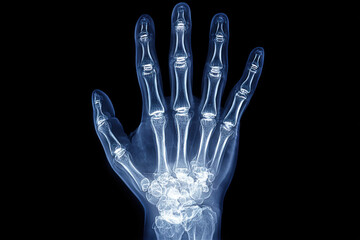 Fototapeta premium X-ray photograph of human arm bones