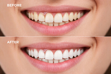 Before and after close-up of woman's teeth whitening transformation