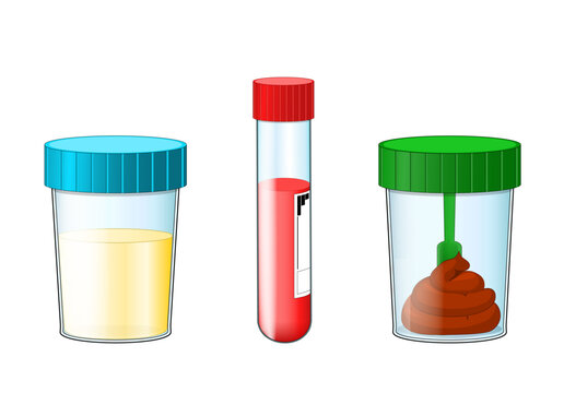 Samples for Medical Diagnostics. Laboratory test tube containing blood specimen. Urine and stool in plastic jars for Medical analysis.