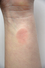 Fototapeta premium Human hand with red skin burn on wrist