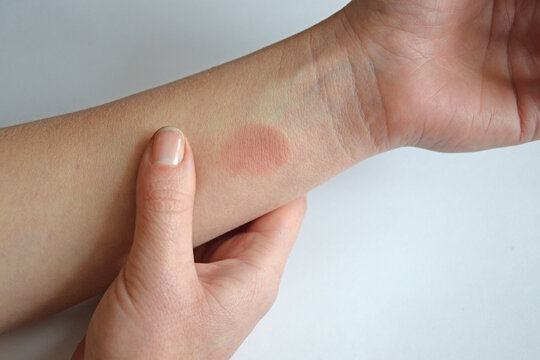 Close up of red burn mark on female hand and wrist