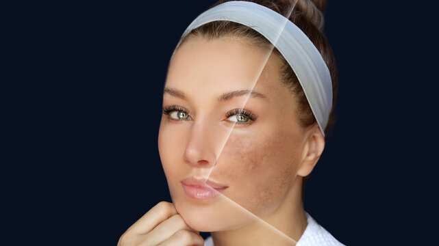 Dark spots, freckles,hyperpigmentation(melasma or chloasma)