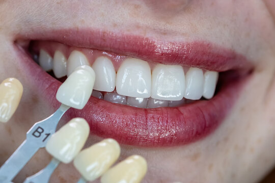 Shade selection for veneers or crowns using dental color guide near patient&rsquo;s smile. Aesthetic dentistry concept, perfect white teeth and professional smile makeover consultation.