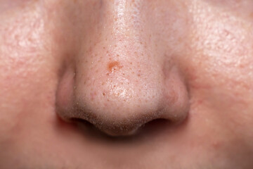 Close up of human nose with visible pores and blackheads. Macro dermatology photography of oily skin texture. Skincare and cosmetology concept. Design for banner, poster, wallpaper, header. Macro shot