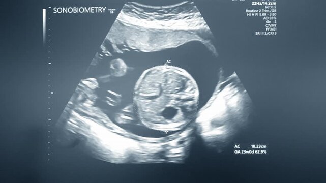 Ultrasound on monitor close-up. Ultrasound image on computer monitor screen. Ultrasound examination. Sonography sonogram. Monitoring diagnostic medical healthcare system. Ultrasonography ultrasonic.