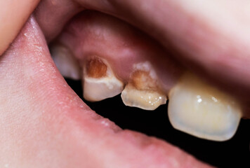 Close-up view of child mouth showing severe dental decay and enamel hypoplasia on upper front teeth caused by excessive sugar intake © HENADZY