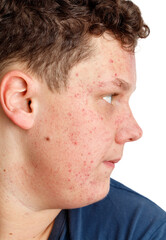 A boy with a red face