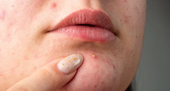 Acne on skin closeup photo. Dermatology concept with acne skin pores. Macro shot of skin irritation with acne. Irritated acne skin.