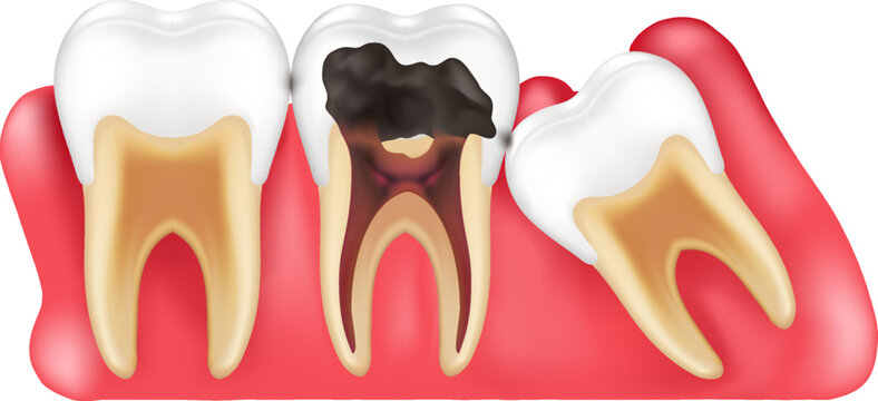 vector 3D medical illustration showing impacted wisdom tooth pushing healthy molar with inflamed red gums gingivitis professional dentistry education and healthcare marketing concept