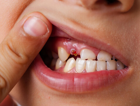 Close up of childs mouth showing inflamed gum and broken tooth teeth