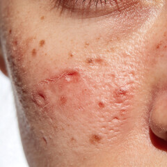 Fototapeta premium Close-up of skin with acne and blemishes on a person's face 