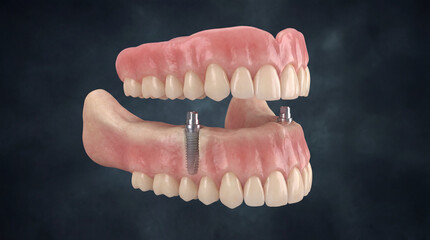 Fototapeta premium dental implants dentures, teeth replacement, medical concept, oral health