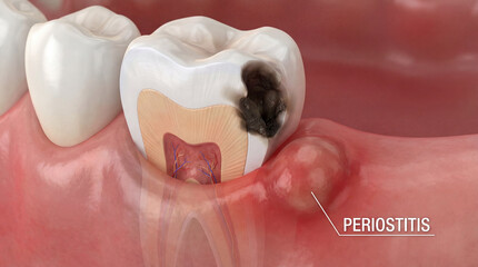 Fototapeta premium Dental caries and periostitis illustration, tooth infection