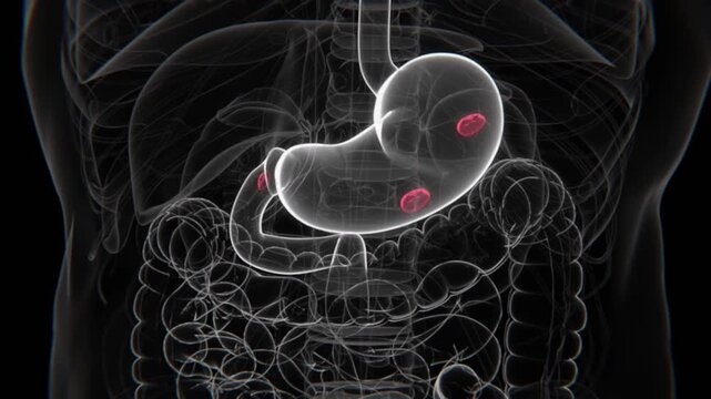 Peptic Ulcers and Duodenal Ulcers Indication Video | Multiple Ulcers in stomach in HD Video