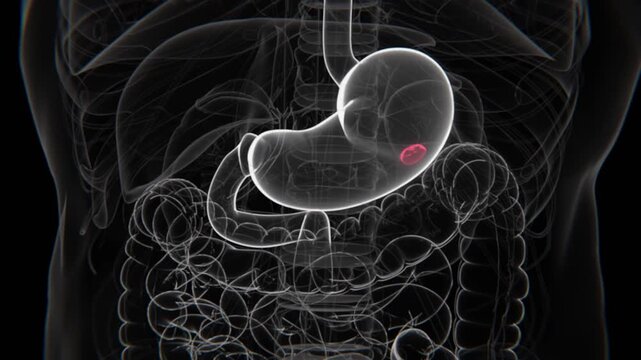 Peptic Ulcers Indication in HD Video | Ulcers in stomach in HD Video