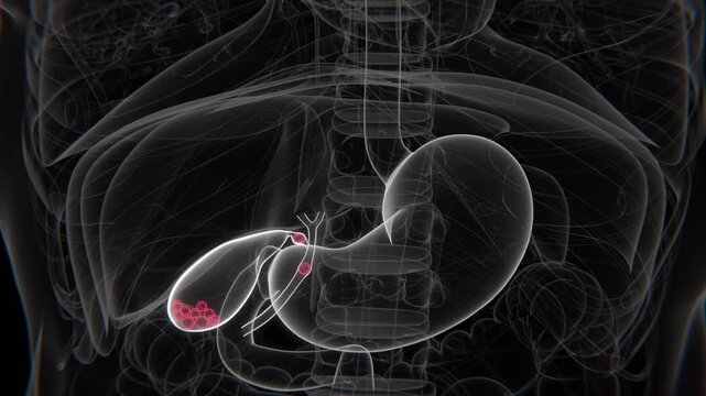 Bile Duct Obstruction Indication X-Ray HD Video | Bile Duct Obstruction in HD X-Ray Video