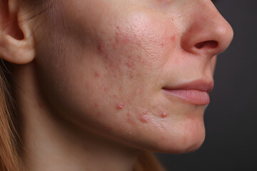 Skin close-up showing acne scars and blemishes on a woman's cheek in a well-lit indoor setting