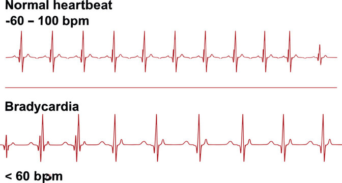 Comparison of normal heartbeat and bradycardia electrocardiogram waveforms showing different heart rhythm patterns.