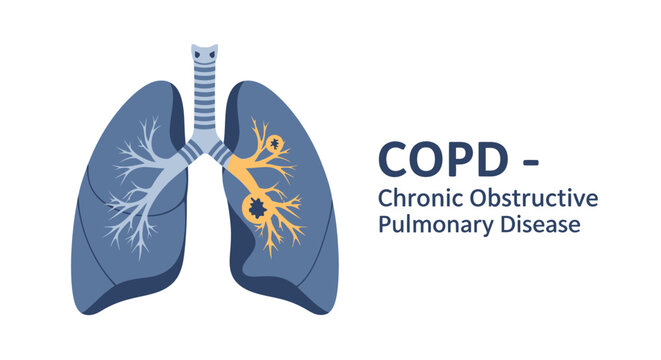 Medical illustration of human lungs showing Chronic Obstructive Pulmonary Disease (COPD) symptoms. Respiratory system health concept.