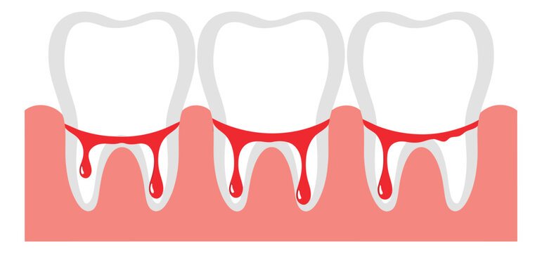 Modern illustration of bleeding gums depicting gingivitis for dental health awareness
