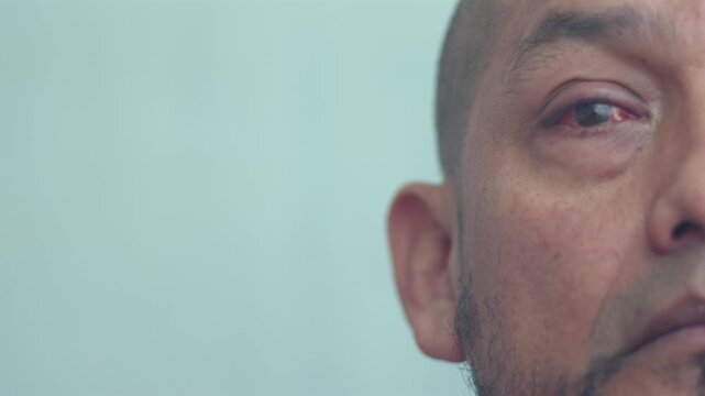 A man is slowly focused on and shows his right eye after pterygium surgery.