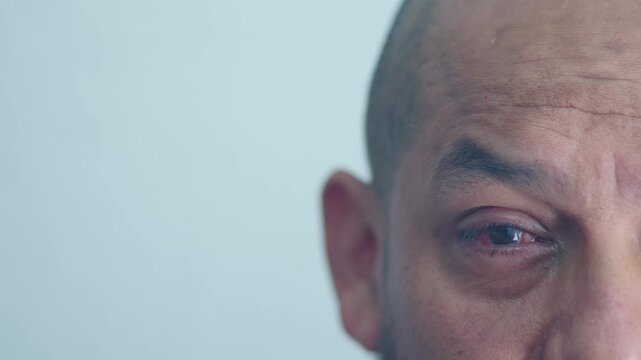Patient looking straight ahead at the camera, showing a close-up of their right eye, which has undergone surgery for pterygium.