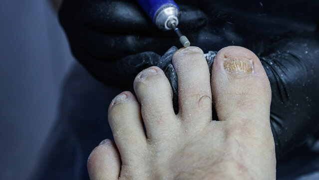 Treatment of nails affected by nail fungus.