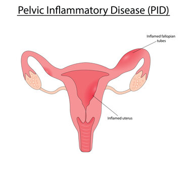 Pelvic inflammatory disease vector illustration