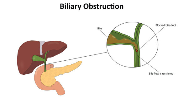 Biliary obstruction vector illustration
