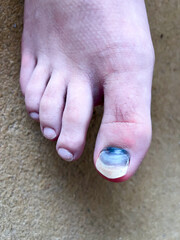 A blackened big toenail on a child&rsquo;s foot.