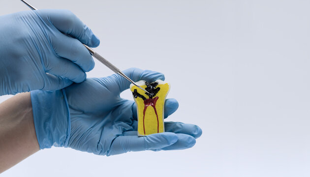 Dentist pointing at decayed tooth model with explorer