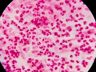 Obraz premium Microscopic view of a Gram-stained smear showing an abundance of polymorphonuclear leukocytes (neutrophils). The cells exhibit characteristic multi-lobed nuclei against a proteinaceous background