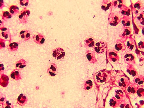 Intracellular Neisseria gonorrhoeae bacteria with gram staining, viewed under a microscope.	