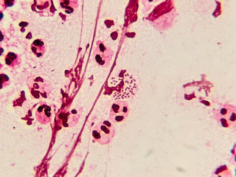 Intracellular Neisseria gonorrhoeae bacteria with gram staining, viewed under a microscope.	