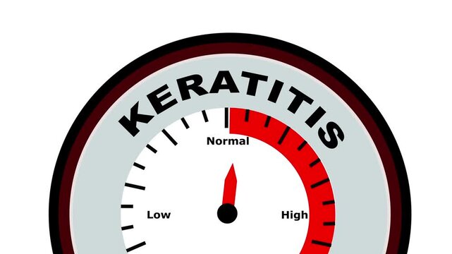 Keratitis text or word shown with a barometer or tachometer-style gauge, representing varying levels of severity in inflammation of the cornea and its impact on vision and eye health.