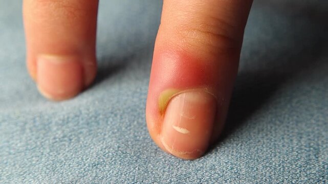 Acute paronychia infection on a fingernail with redness, swelling, and pus. Medical dermatology concept, nail fold inflammation, bacterial infection, pain, hygiene and treatment needs for healthcare.
