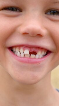 Happy boy laughing showing missing front tooth. Close up of smiling child with milk tooth gap.