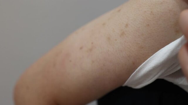 腕の色素沈着。茶色い斑点のクローズアップ。
