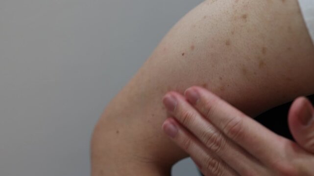 腕の色素沈着。茶色い斑点のクローズアップ。